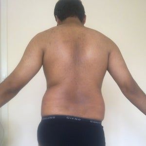 Liệu da của tôi có bị chảy xệ/lỏng lẻo sau hút mỡ không?