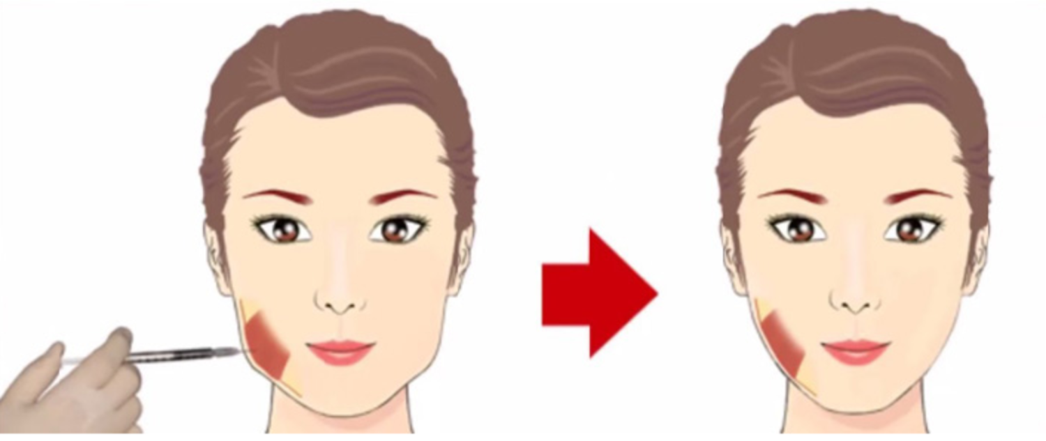 Vị trí tiêm Botox vào cơ cắn