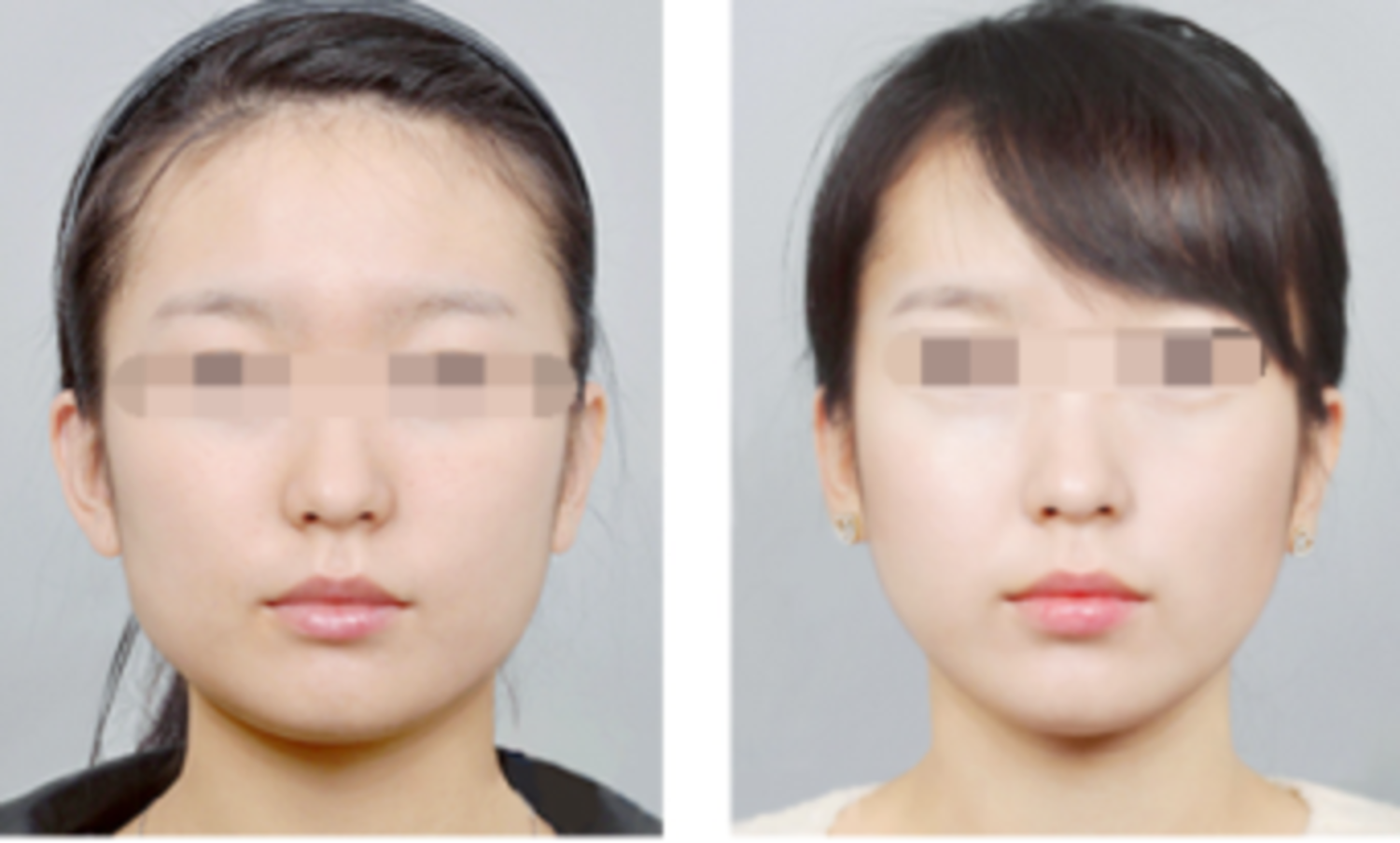 Bệnh nhân trước và sau tiêm botox thon gọn hàm