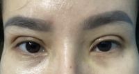 Mí mắt không đều, mắt lệch cao thấp