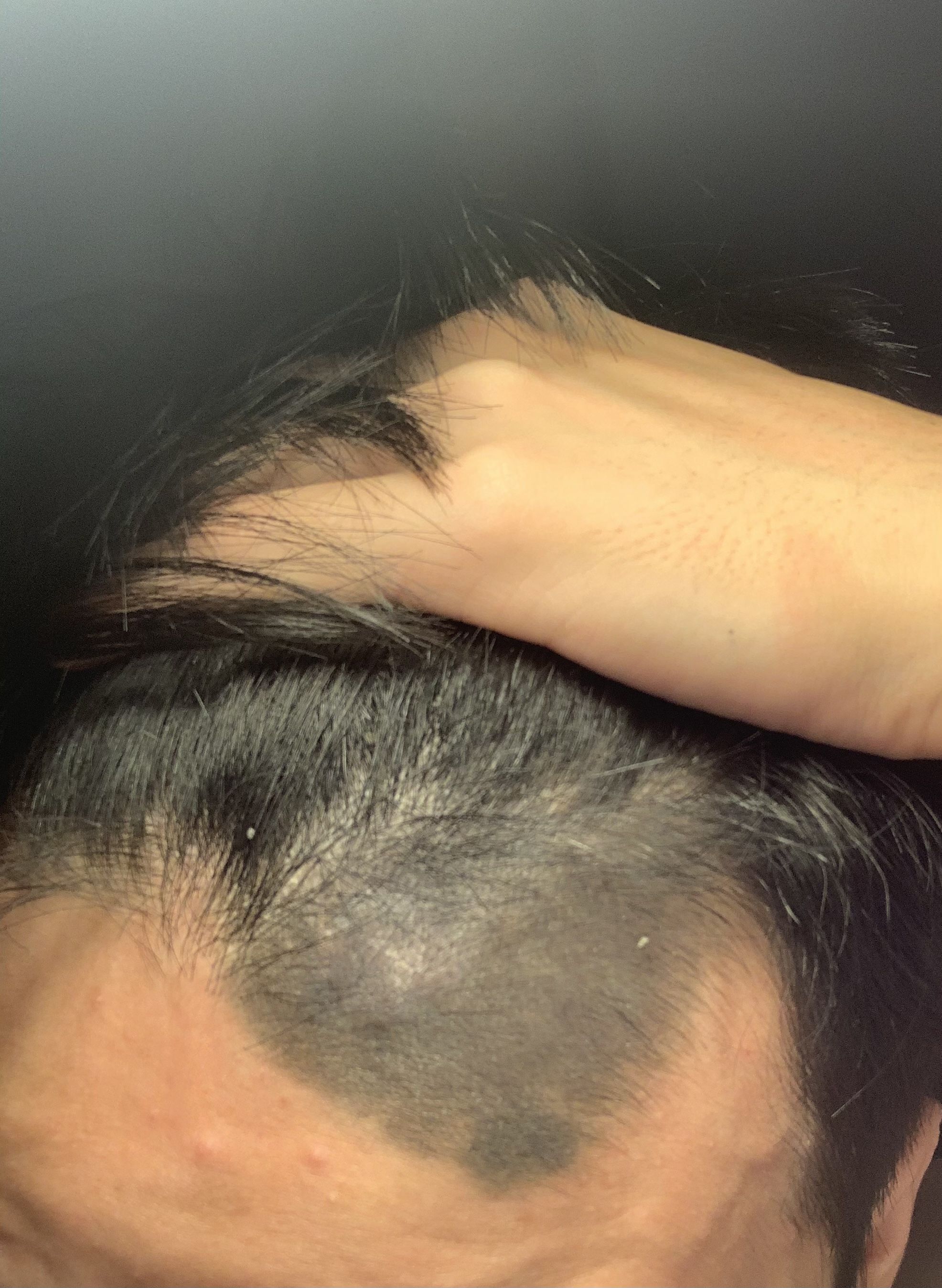 Tẩy vết chàm đen bẩm sinh Tẩy vết chàm đen bẩm sinh