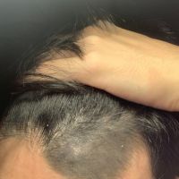 Tẩy vết chàm đen bẩm sinh