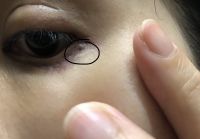 Cắt mí có cục ở mắt