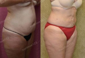Hút mỡ bụng, nữ 41 tuổi - ca 1