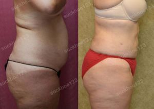 Hút mỡ bụng, nữ 41 tuổi - ca 1