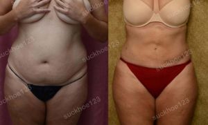 Hút mỡ bụng, nữ 41 tuổi - ca 1
