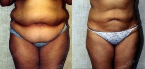 Hút mỡ bụng thể tích lớn, nữ 27 tuổi - ca 24