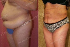 Hút mỡ bụng thể tích lớn, nữ 43 tuổi - ca 26