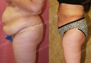 Hút mỡ bụng thể tích lớn, nữ 43 tuổi - ca 26