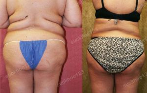 Hút mỡ bụng thể tích lớn, nữ 43 tuổi - ca 26