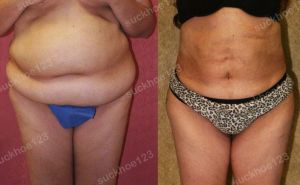 Hút mỡ bụng thể tích lớn, nữ 43 tuổi - ca 26