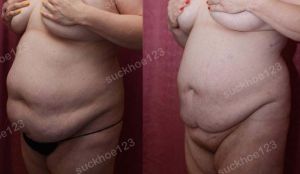 Hút mỡ bụng thể tích lớn, nữ 37 tuổi - ca 27