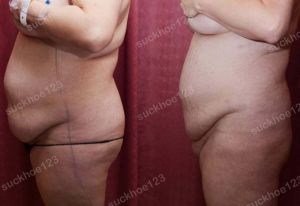 Hút mỡ bụng thể tích lớn, nữ 37 tuổi - ca 27