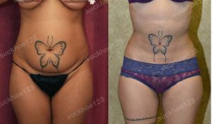 Hút mỡ bụng, nữ 27 tuổi - ca 3