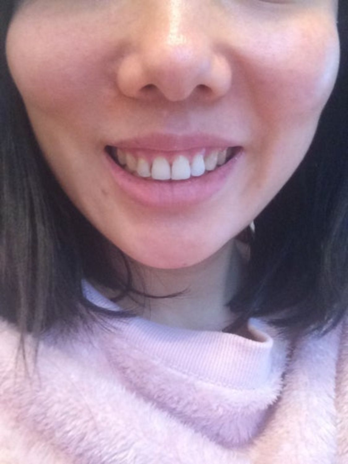 Hai bên má bị hóp sau tiêm botox gọn hàm