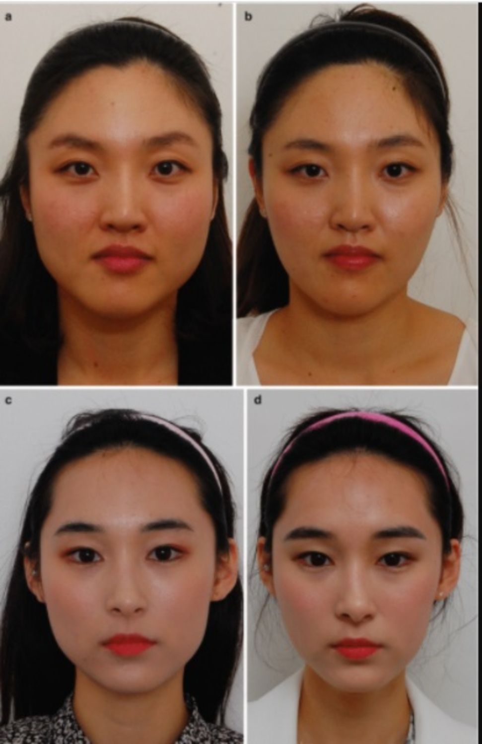 Các hình ảnh cơ cắn phì đại gây hàm bạnh: trước và sau khi tiêm botox 