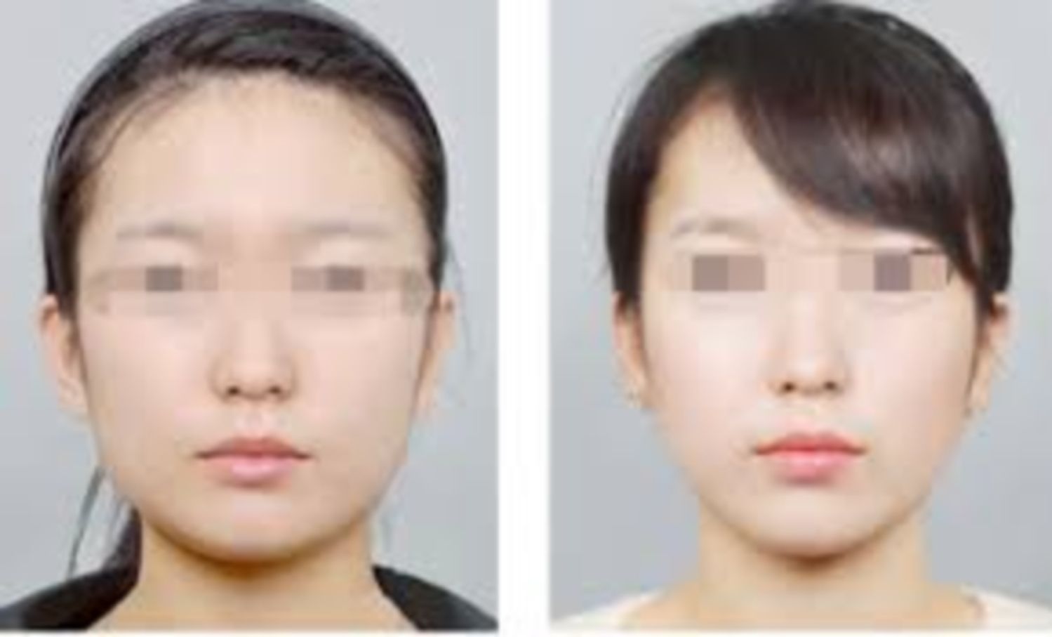 Tiêm Botox gọn hàm làm nhỏ cơ cắn