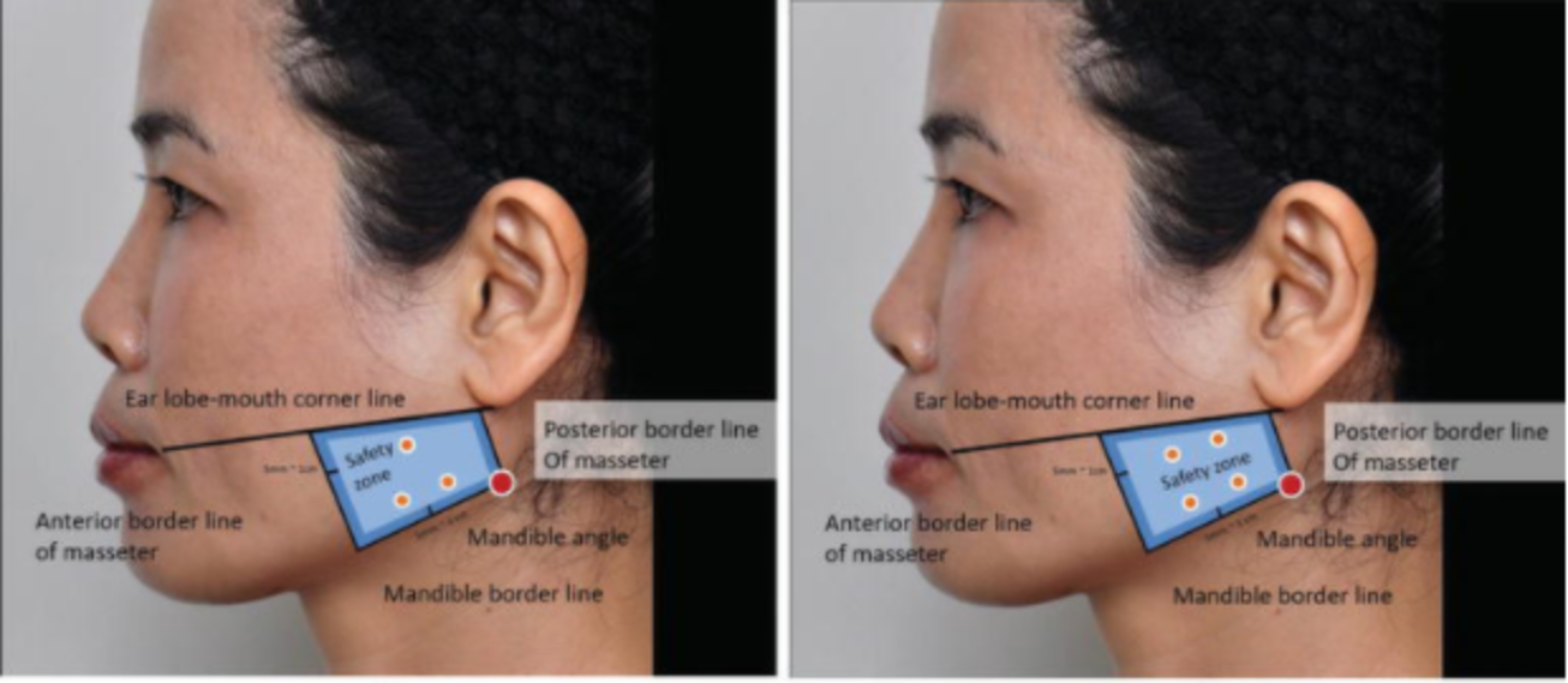 Đánh dấu điểm tiêm