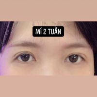 Mí cắt bị sưng sau 1 tháng