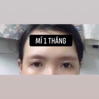 Mí cắt bị sưng sau 1 tháng