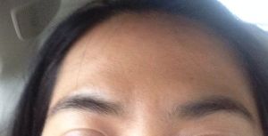 Bị sưng xung quanh và phía trên lông mày sau khi tiêm botox xóa nếp cau mày như này có bình thường không?