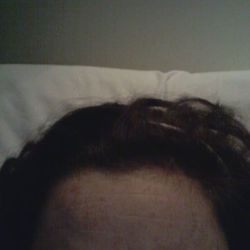 Phương pháp điều trị tốt nhất để xóa nếp nhăn tĩnh ngang trán và ở vùng gian mày của tôi là gì?