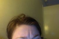 Xóa nếp nhăn dọc trên trán