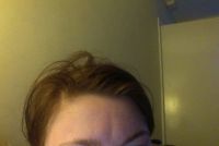 Xóa nếp nhăn dọc trên trán