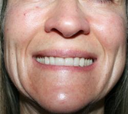 Xuất hiện nhiều rãnh cười hơn sau khi tiêm botox xóa nếp nhăn đuôi mắt