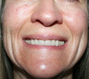 Xuất hiện nhiều rãnh cười hơn sau khi tiêm botox xóa nếp nhăn đuôi mắt