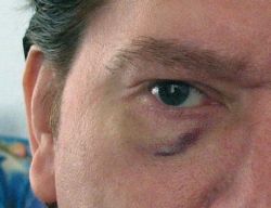 Vùng dưới mắt thâm đen sau khi tiêm botox xóa nếp chân chim