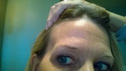 Teo cơ thái dương sau lần tiêm botox xóa nếp chân chim đầu tiên?