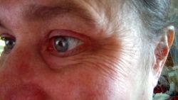 Nên dùng Botox hay Juvederm để xóa những nếp nhăn vùng mắt này?