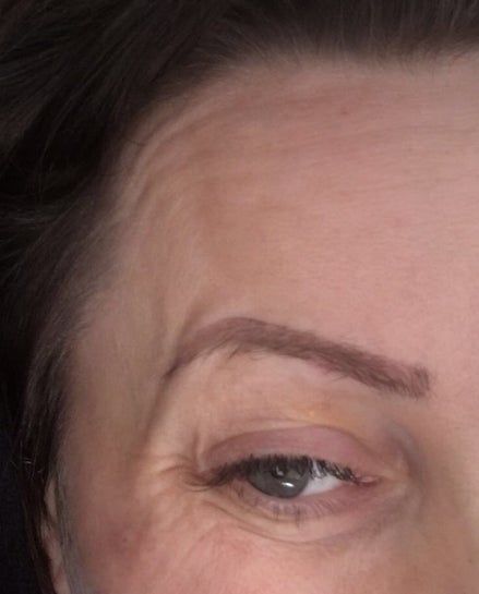 Sau tiêm botox xóa nếp chân chim: cơ của tôi như này là bị làm sao? Sau tiêm botox xóa nếp chân chim: cơ của tôi như này là bị làm sao?