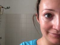 Có phải mỡ dưới mắt tôi phình ra như này là do botox không?