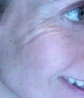 Botox có thể xóa những nếp nhăn kỳ lạ này không?