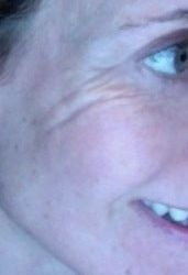 Botox có thể xóa những nếp nhăn kỳ lạ này không?