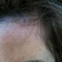 Tại sao tôi lại có đường lõm/nếp nhăn như này sau khi tiêm botox xóa nếp nhăn trán?