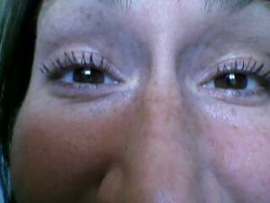 Mí mắt sưng nặng, mờ mắt, xuất hiện bọng mắt và đau đầu sau khi tiêm botox xóa nếp nhăn trán?