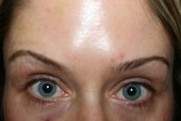 Lông mày bên cao bên thấp, sưng phình dưới mắt, má xệ sau khi tiêm botox xóa nếp cau mày và nếp chân chim
