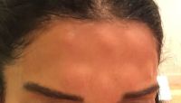 Có phải do uống thuốc làm loãng máu như Vitamin E trước khi tiêm botox vào trán nên bị nổi cục như này không?