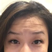 Mặt lúc nào cũng như đang giận dữ sau tiêm botox ở trán và gần lông mày