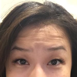 Mặt lúc nào cũng như đang giận dữ sau tiêm botox ở trán và gần lông mày