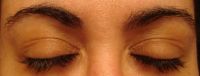 Lông mày sụp, biến dạng sau khi tiêm botox