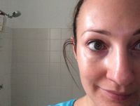 Có phải mỡ dưới mắt tôi phình ra như này là do botox không?