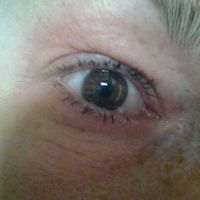 Mí mắt sưng nặng, mờ mắt, xuất hiện bọng mắt và đau đầu sau khi tiêm botox xóa nếp nhăn trán?
