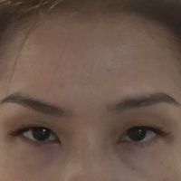 Mặt lúc nào cũng như đang giận dữ sau tiêm botox ở trán và gần lông mày