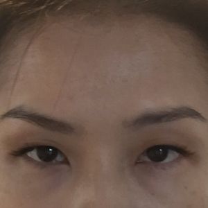 Mặt lúc nào cũng như đang giận dữ sau tiêm botox ở trán và gần lông mày