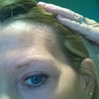 Teo cơ thái dương sau lần tiêm botox xóa nếp chân chim đầu tiên?