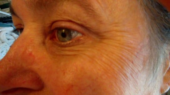 Nên dùng Botox hay Juvederm để xóa những nếp nhăn vùng mắt này?